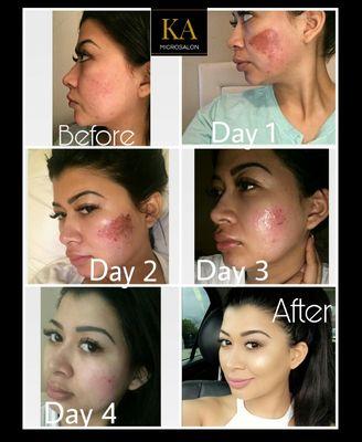 Acne scar result's after three microneedling procedures