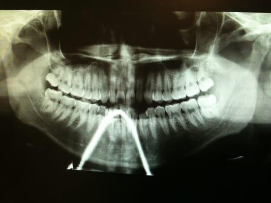 Panoramic X-rays!