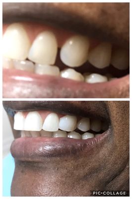 Dr. B fixed this in 30 minutes, when other dentists stated it could not be done,  HE IS THE FIXER!