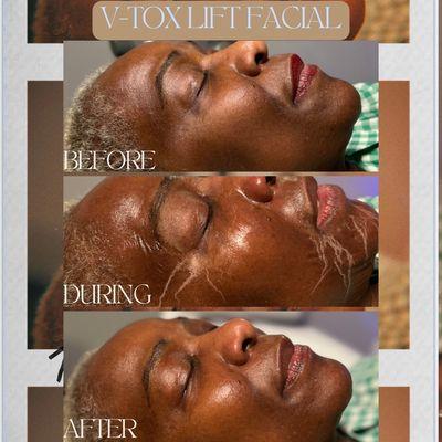 V-Tox Lifting Facial