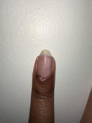 Bleeding cuticle