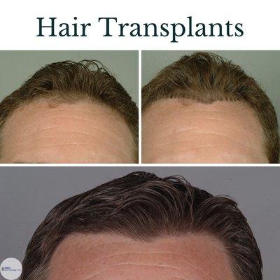 Hairline transplant