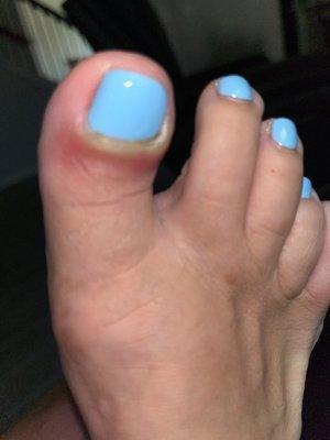 Infection after pedicures