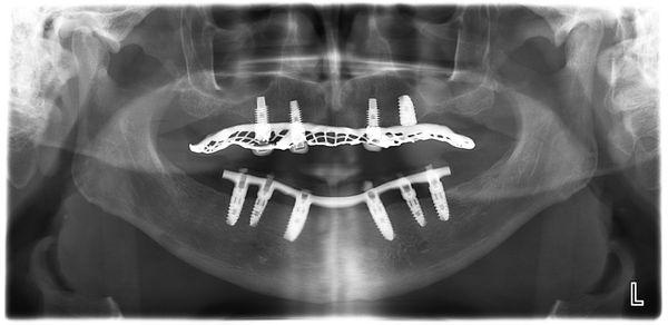 Dental Implant Supported Dentures