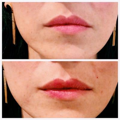 This patient wanted a fuller top lip and to correct an asymmetry of the bottom lip.