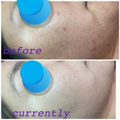 client cleared of acne in 6 months