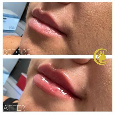 Lip Filler before and after