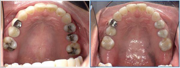 Safe amalgam removal before and after