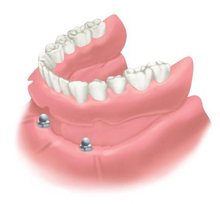 Removable Denture Held By  2 Implant Anchors.