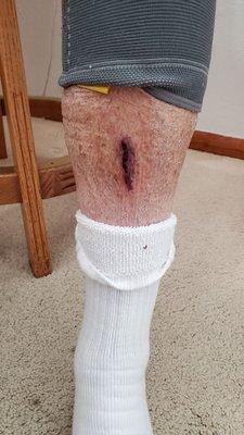 Severe cut on left leg below knee