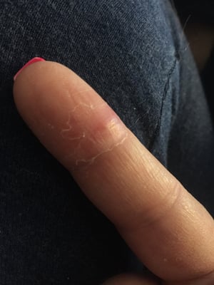 Dog bitten finger