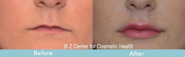 Lip enhancement with filler by Dr Zadeh