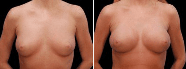 Breast Augmentation Before & After