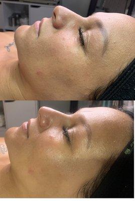 Facials (Prenatal)