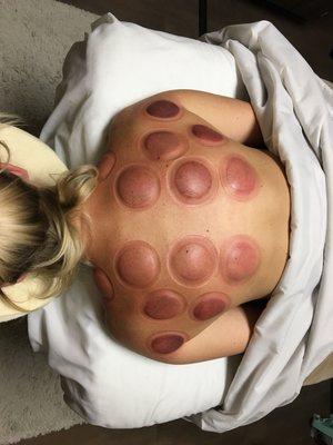 Cupping for shoulder and neck pain/tension. These are not bruises.