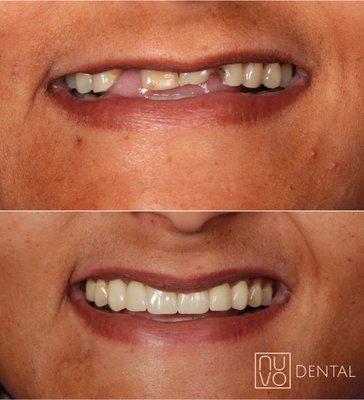 Transform your smile and boost your confidence with our tailored smile designs!