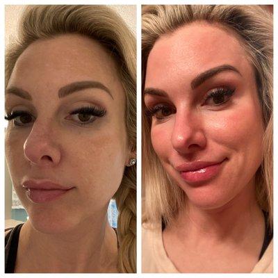 Results from Moxi gentle laser resurfacing for skin tone and texture!