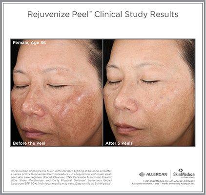 Rejuvenize Peel    for Brown Pigment, Fine Lines,       and turning over the skin