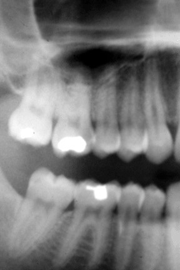 Dental x-rays to see what problems may exist underneath your smile