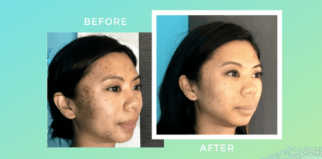 Cosmetic acupuncture Before and After