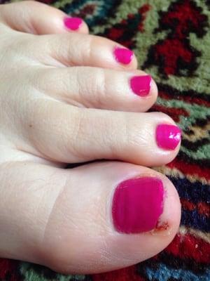 A close up photo of my botched big toe to go with my review. Avoid pedicures at Kelly's.