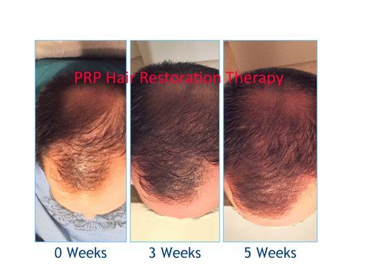 Platelet-Rich-Plasma hair restoration