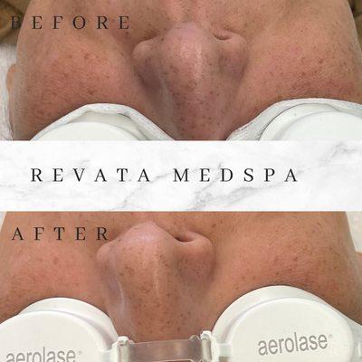 Revata Medspa Laser Facial