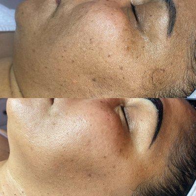 Dermaplane Facial