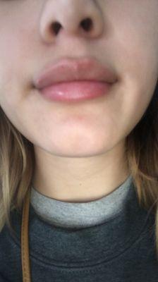 Immediately after filler, still swollen but let me know if anyone would like an update with a picture of my healed lips!