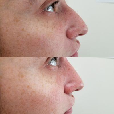 NON-surgical nose job