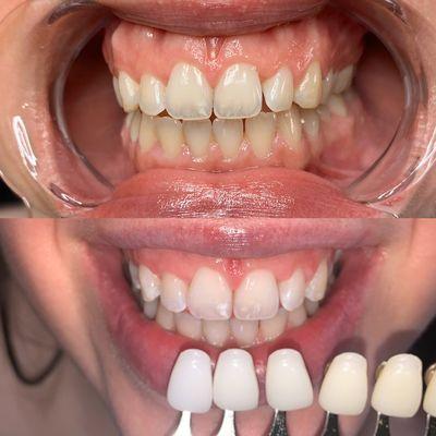 1 hr teeth whitening