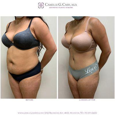 Before and 6 weeks after a tummy tuck with 360 lipo