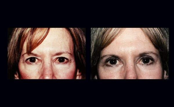 Blepharoplasty