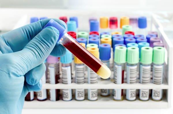 Fermentation and contamination can result in an unreliable and flawed DUI blood sample. Our lawyers can reveal this to the court.