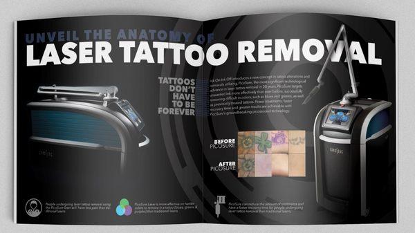 Tattoo Removal