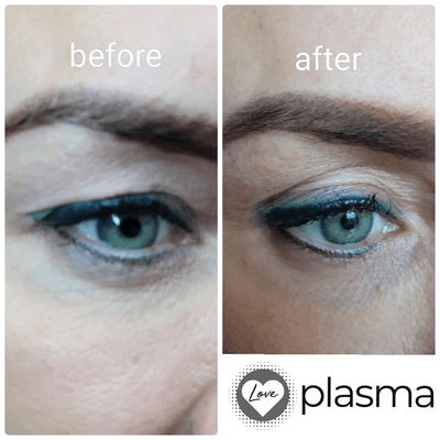 New Fibroblast Plasma! Non invasive treatment for skin tightening, facelift and more... Lift up eyelid! Instant result and last for years.