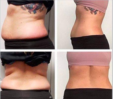 Reduce inches with the help of Cryoskin Slimming and Toning