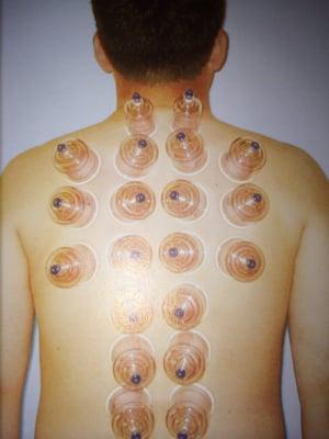 Cupping Therapy