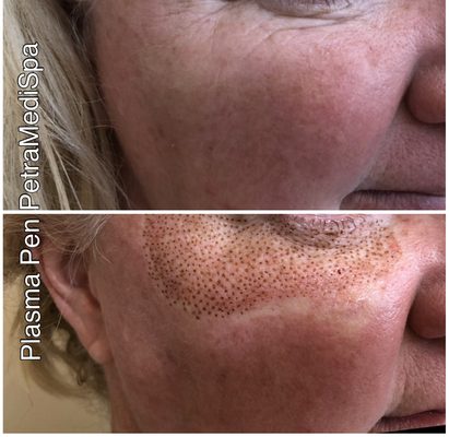 Plasma Pen before and right after treatment.