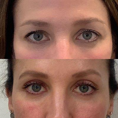 Before & After - Plasma pen for drooping eyelids is amazing!!!!