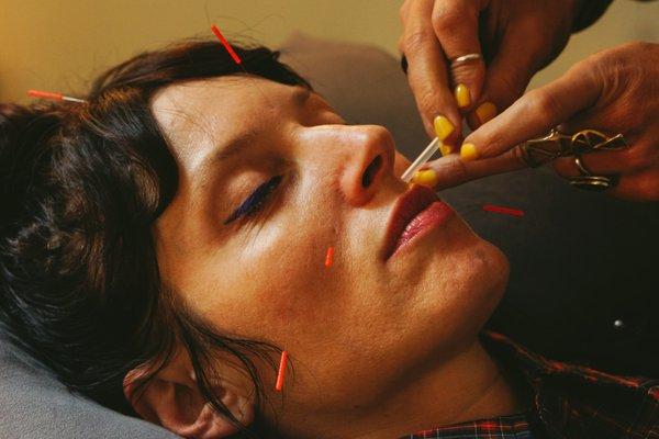 face acupuncture