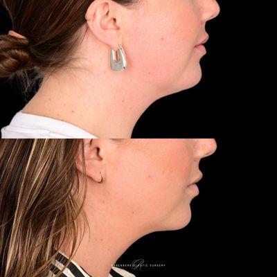 Before and After | Neck Liposuction