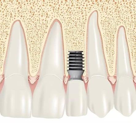 Implant Dentistry of Northshore