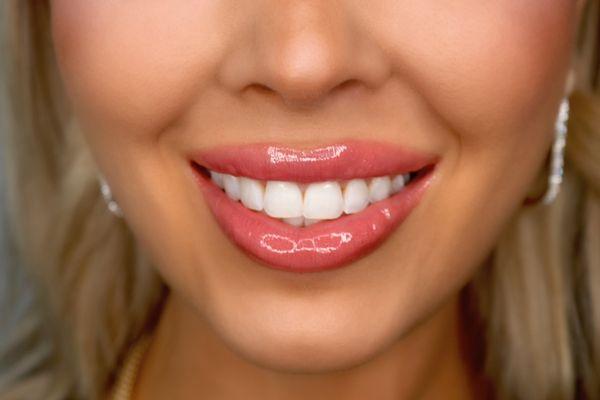 Professional teeth whitening