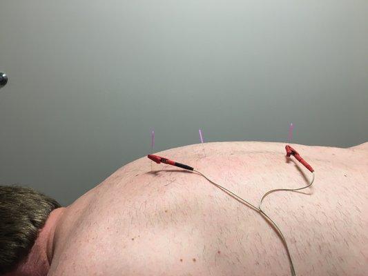 Dry needling upper back using a TENS unit