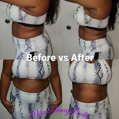 Body Contouring. Laser Lipo