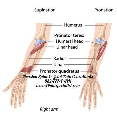 Pronator Teres Syndrome:Call 832-777-PAIN and consult our Arm Pain Doctor. At our Pain Management Clinic we treat Spine and Joint Pain.