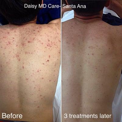 Summer is around the corner, if you are suffering from back acne we can help get you summer ready.