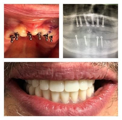 Same day implant placement and making dentures fixed.