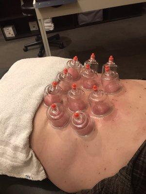 Cupping!!